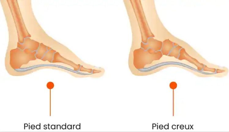 Soins du Pied SCM Podologie du Sport Niort 79